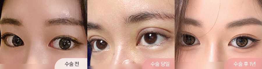 12홀 자연유착과 윗트임 수술 전, 수술 당일, 수술 후 1년 경과 비교