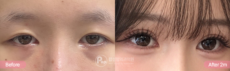 풀린 쌍꺼풀 눈재수술 자연유착 눈매교정 윗트임 수술 전과 2개월 후 비교