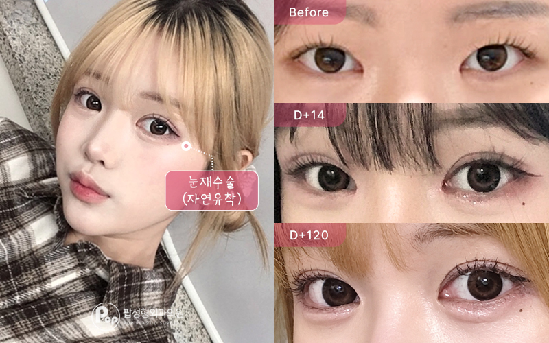 풀린 쌍꺼풀 눈재수술 자연유착 눈매교정 앞트임 윗트임 수술 전, 14일, 120일 경과 비교